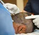Police Constable died after hair transplantation