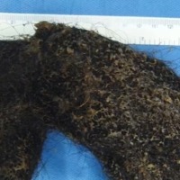 Doctors at Hyderabad hospital remove hairball from Omani girl