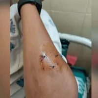 Angry lecturer bites student for cheating during examination