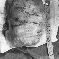 Doctors at SLG Hospitals remove a 3 kgs giant fibroid from a woman