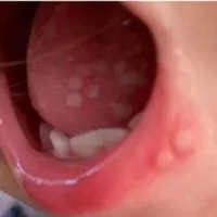 Kerala registers new cases of Tomato Flu Virus