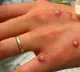 WHAT IS MONKEYPOX