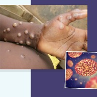 TS government on alert on monkeypox