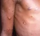 Suspected Monkey Pox Case In India