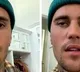 Justin Bieber says he is suffering from facial paralysis