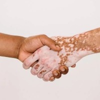 Signs to detect Vitiligo