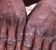 US at risk of losing control of monkeypox outbreak