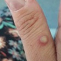 Testing remains a challenge for monkeypox: WHO