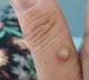 Testing remains a challenge for monkeypox: WHO
