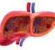 Non Alcoholic Fatty liver decease symptoms