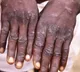 Monkeypox symptoms reported in traveller from UAE