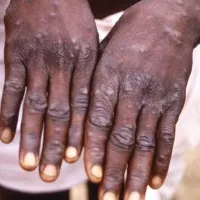 One case of monkeypox infection confirmed in Kerala