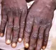 One case of monkeypox infection confirmed in Kerala