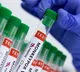 Monkeypox spreads to over 60 countries India sees 1st case
