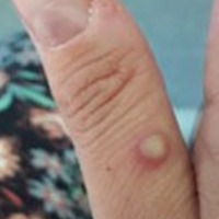 Monkeypox: TN intensifies surveillance at Kerala borders