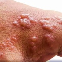 Suspected monkeypox patient in Andhra tests negative