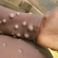 Third monkeypox case confirmed in kerala