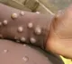 Third monkeypox case confirmed in kerala