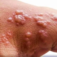 Delhi reports first monkeypox case