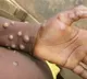 Delhi airports on alert for monkeypox case detected national capital