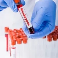 A single lesion could also hint at monkeypox infection UK Health agency