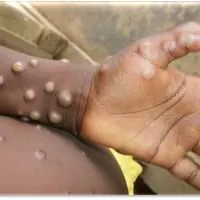 Indias first monkeypox patient recovers and skin rash completely cured