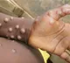 Indias first monkeypox patient recovers and skin rash completely cured