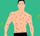 Monkeypox vs chickenpox key differences according to doctors