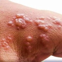 Delhi's 1st monkeypox patient recovers, discharged from hospital