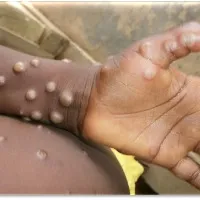 public wants to rename monkeypox as Trump 22