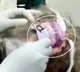 Head Wound Dressed With Condom Pack At Madhya Pradesh Health Centre