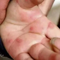 What is Tomato flu that is spreading in India