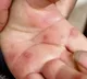 What is Tomato flu that is spreading in India