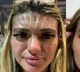 Woman Shocked To Find Forehead Skin Looking Like Plastic Claims She Slept Under Sun