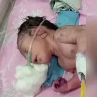 Baby born with horn like structure instead of legs in Madhya Pradesh