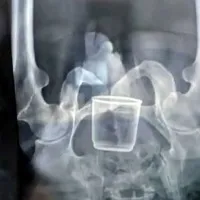 Glass found in stomach of elderly man claims he was made to sit on it in Madhyapradesh