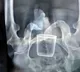 Glass found in stomach of elderly man claims he was made to sit on it in Madhyapradesh
