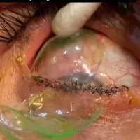 Doctor removes 23 contact lenses from woman eye