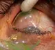 Doctor removes 23 contact lenses from woman eye