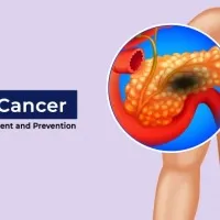 Pancreatic cancer could be diagnosed up to three years earlier new study