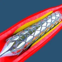 Coronary Stent Is Now In Essential Medicine List