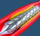 Coronary Stent Is Now In Essential Medicine List