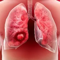 Air pollution major cause of lung cancer in India say health experts