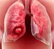 Air pollution major cause of lung cancer in India say health experts