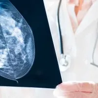 Cancer is preventable Experts reveal how