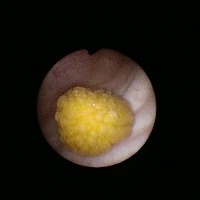 Stones removed from 3-year-old's urinary bladder at Hyderabad hospital