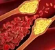 Nutritionist on benefits of bad cholesterol suggests best oils for heart health