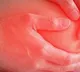 fight Inflammation with these steps