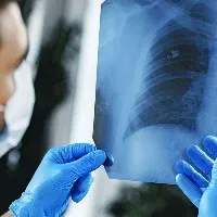 First signs of lung cancer prevention tips by expert
