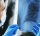 First signs of lung cancer prevention tips by expert